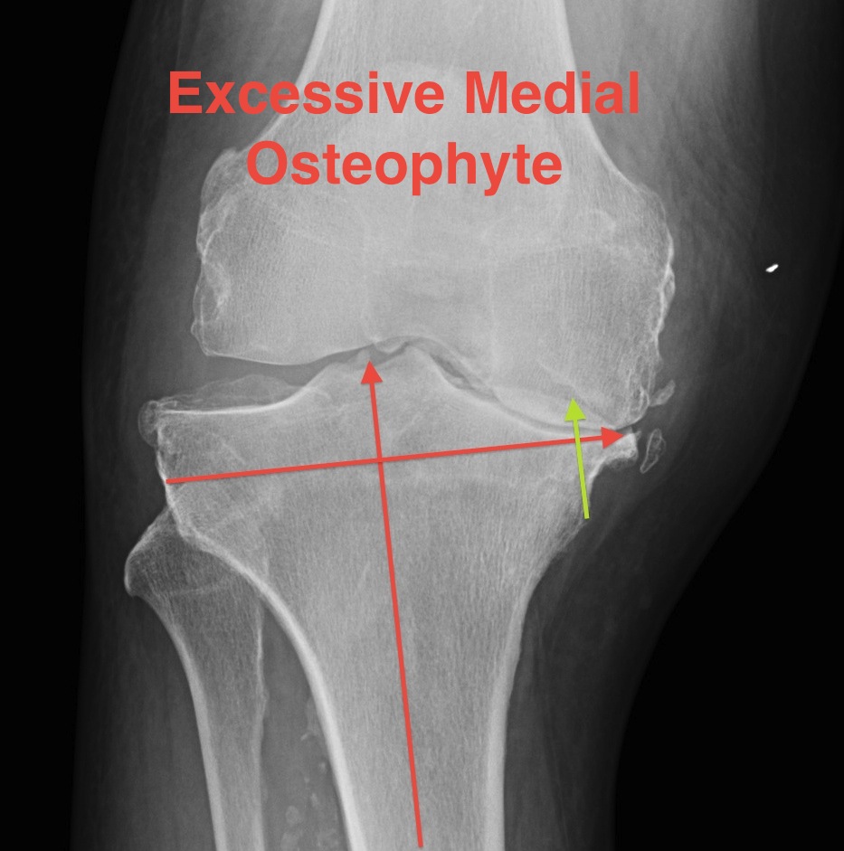 TKR Excessive Medial Osteophyte